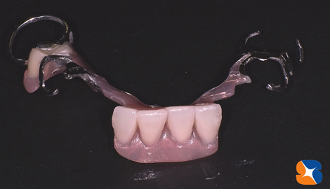 見た目を重視した凝った保険の入れ歯