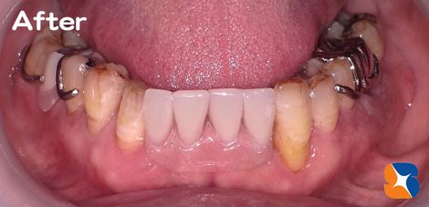 大満足を得た保険の入れ歯