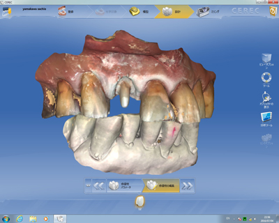 当日にセラミックを院長が作る