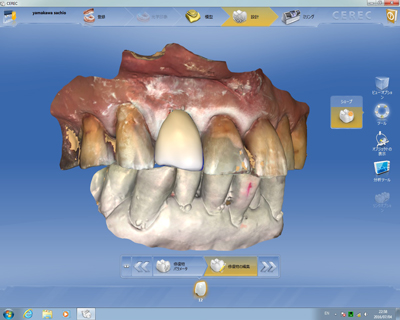院長がその場でセラミックの色の手直し
