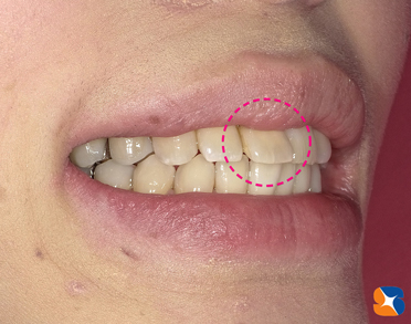 出っ歯で黄色の前歯