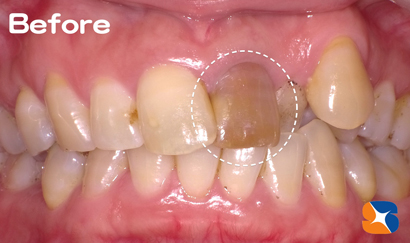 神経のない前歯が変色