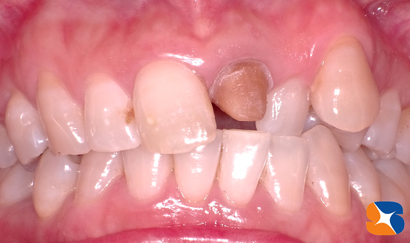 オールセラミックを被すために削る