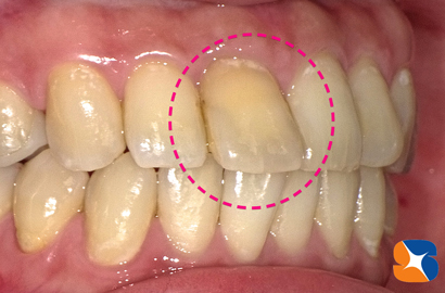 出っ歯で黄色の前歯
