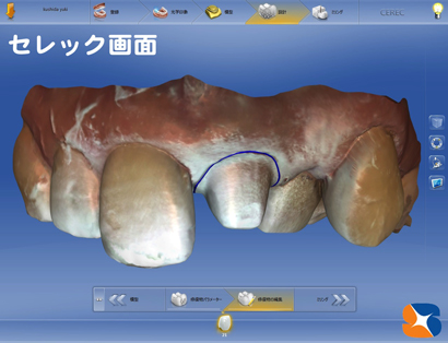 セレックでオールセラミックを製作