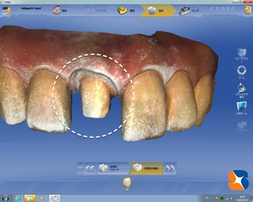 セレックへ読み込み