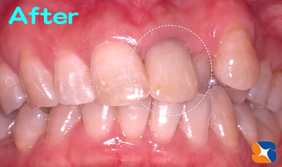 ２回でセラミックを完成させる