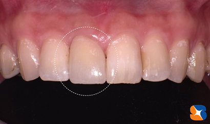 セレックでオールセラミック