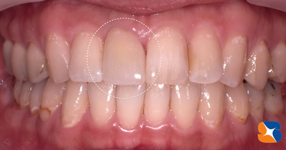 綺麗なオールセラミック