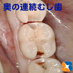 奥歯の連続むし歯