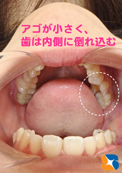 小顔の奥歯のむし歯