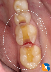 スコープを使って虫歯治療