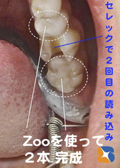 丁寧に細かく分けて治療する
