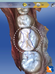 最後の１本をセレックで読み込む