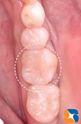 オールセラミックの詰め物