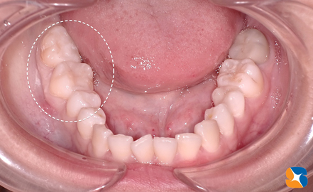 キレイに仕上がった奥歯のオールセラミック