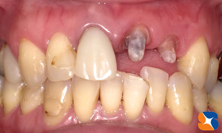 セレックでの読み込む直前