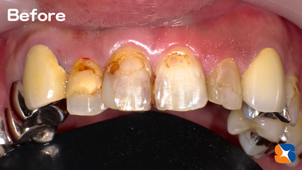 前歯をセラミックに交換