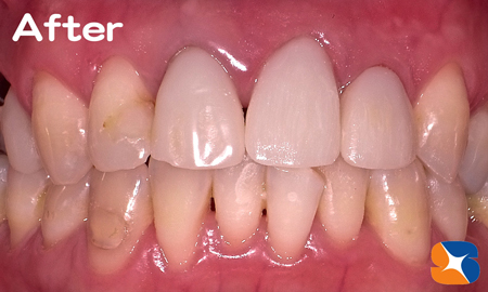 ハイブリッドで完成