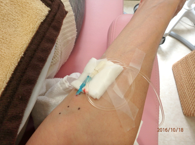 点滴を使ってインプラント手術
