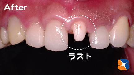 最後の１本をセラミックに交換