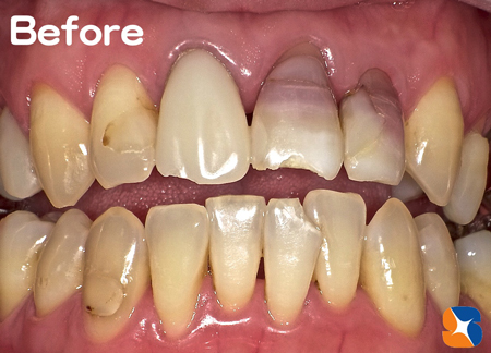 お薬の副作用で前歯が変色