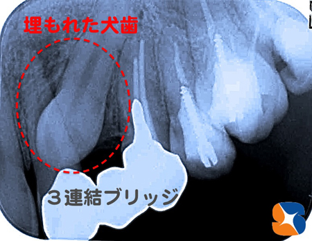 埋もれたままの犬歯