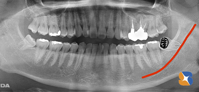 横向き　大きな虫歯の親知らず