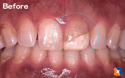 気になる色をした前歯