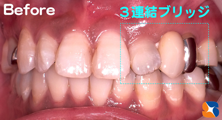 銀歯付きのブリッジ