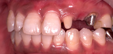 セレックで型取りの準備