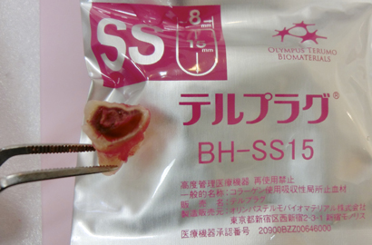 親知らずの抜歯　無料テルプラグ