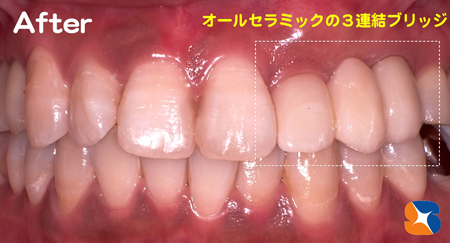 オールセラミックブリッジの完成