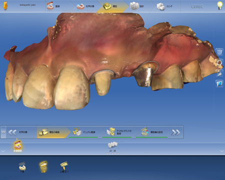 セレックでオールセラミックのブリッジ