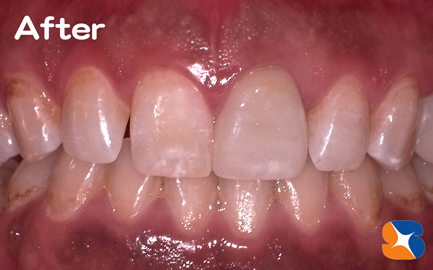 セレックで作ったオールセラミック