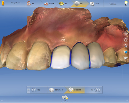 セレックでオールセラミックのブリッジ