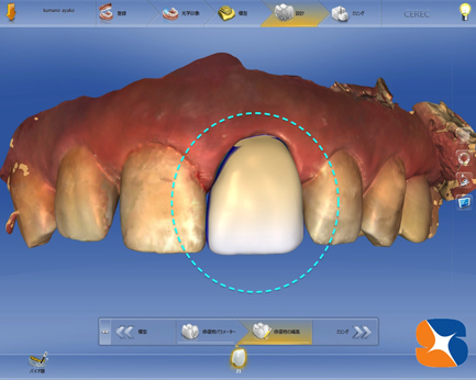 セレックでオールセラミックの形を設計