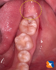 全く歯茎からみえない親知らず