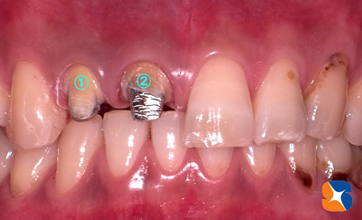 前歯　変色　セラミック　セレック