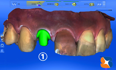 前歯　変色　セラミック　セレック