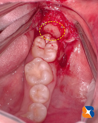 骨に埋もれた親知らず　難度大