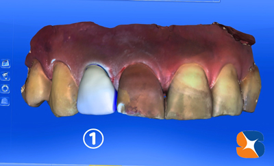 前歯　変色　セラミック　セレック