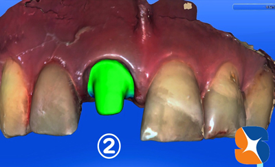 前歯　変色　セラミック　セレック