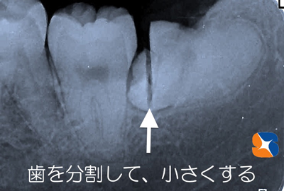 親知らずを細かく分割　難しい親知らず