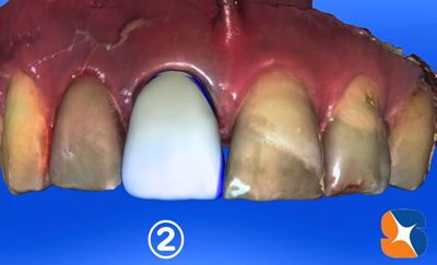 前歯　変色　セラミック　セレック
