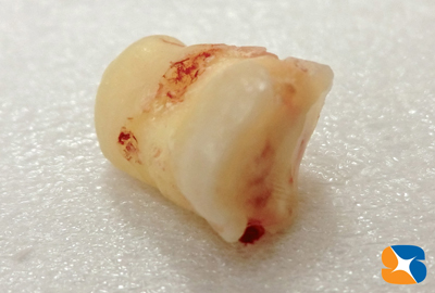 殆ど歯の頭は削られてなくなっています