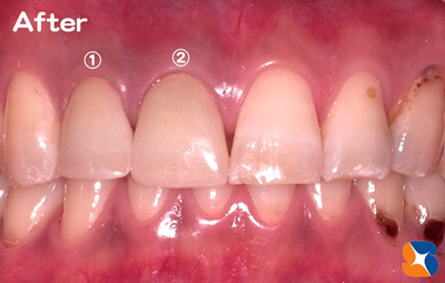 前歯　変色　セラミック　セレック