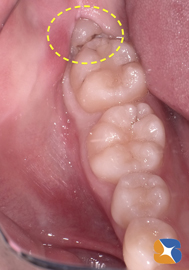横向きの親知らず