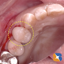 セカンドオピニオン　抜歯　CT