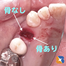 インプラントを前提に抜歯